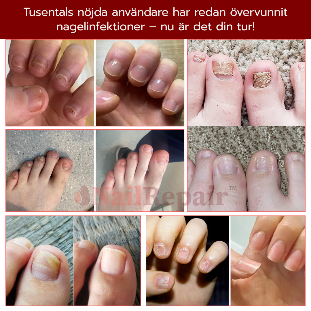NailRepair™ Antimykotisk Nagellösning