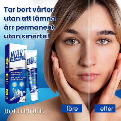 Boldtique Vårtborttagningskräm
